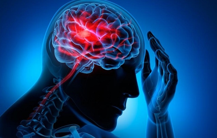 Đột quỵ là căn bệnh vô cùng nguy hiểm.