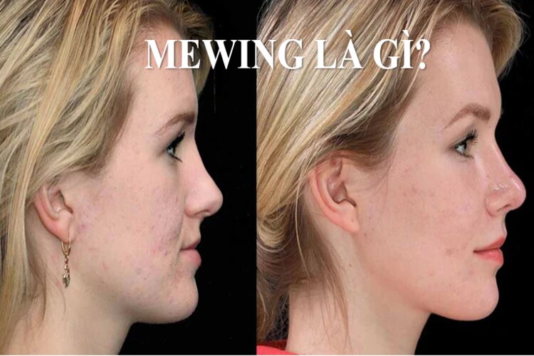 Mewing l&agrave; g&igrave;?